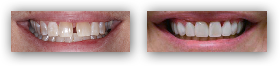 Composite Veneers